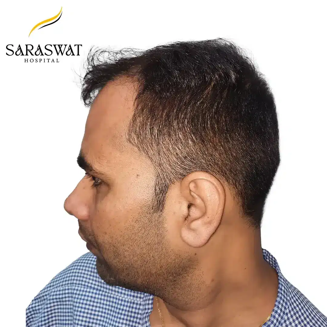 Hair Transplant Before and After Results