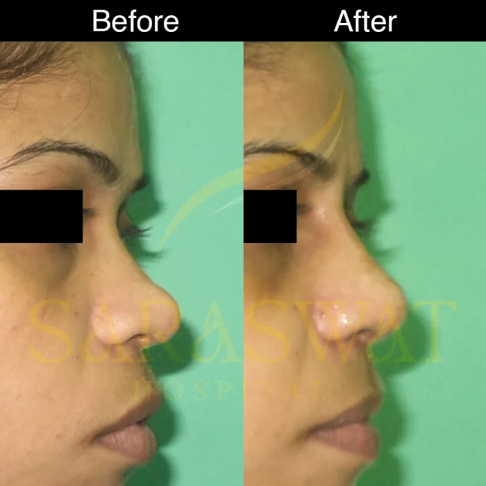 Rhinoplasty Before and After