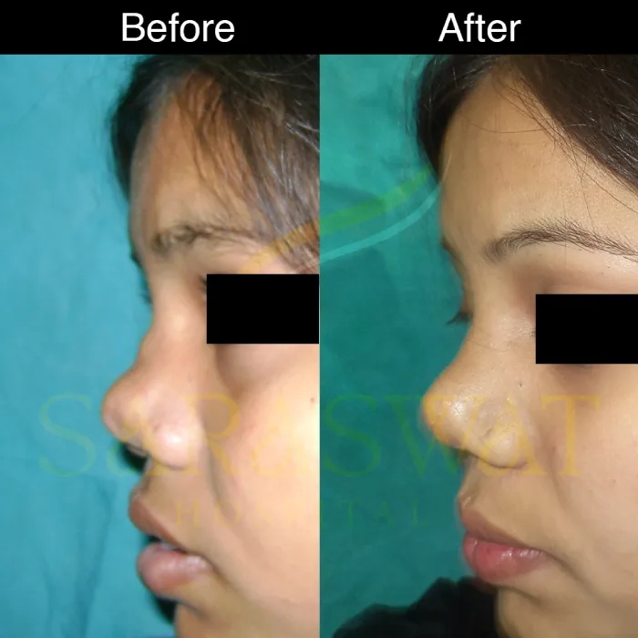 Rhinoplasty Before and After