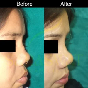 Rhinoplasty Before and After