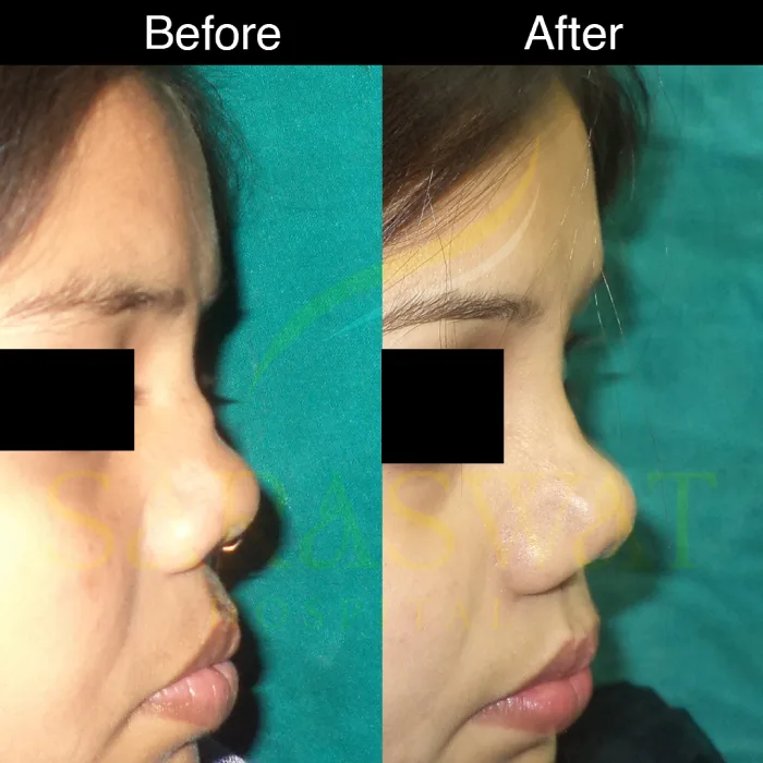 Rhinoplasty Before and After