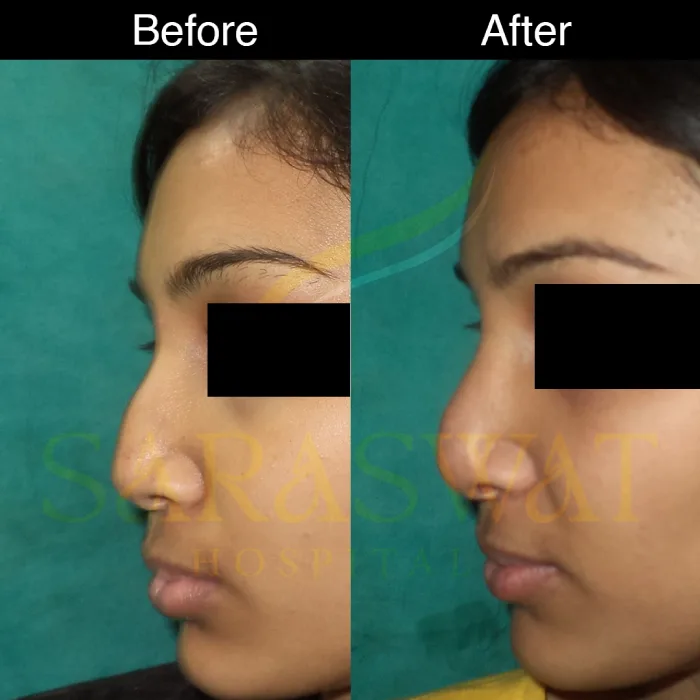 Rhinoplasty Before and After