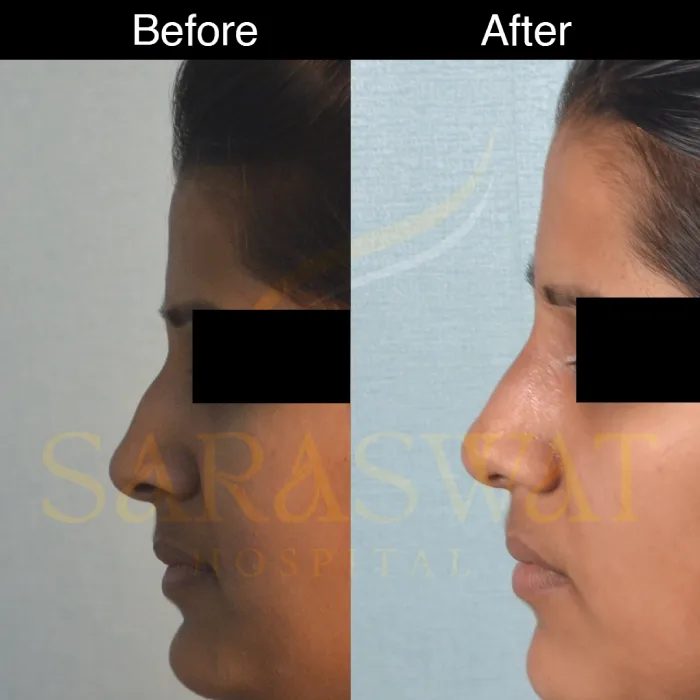 Rhinoplasty Before and After