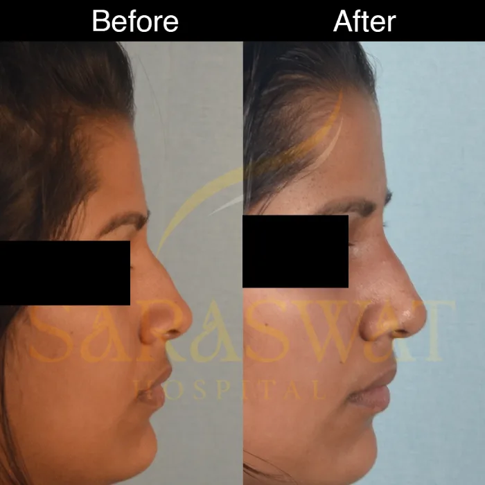 Rhinoplasty Before and After