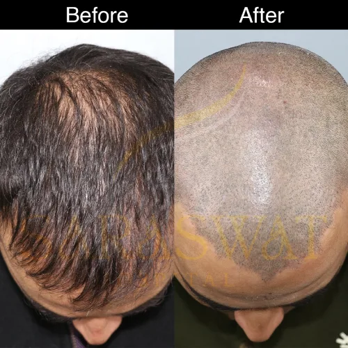 scalp micropigmentation before and after