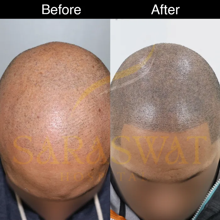 scalp micropigmentation before and after