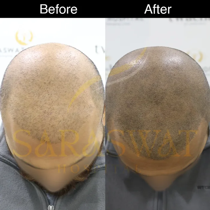 scalp micropigmentation before and after