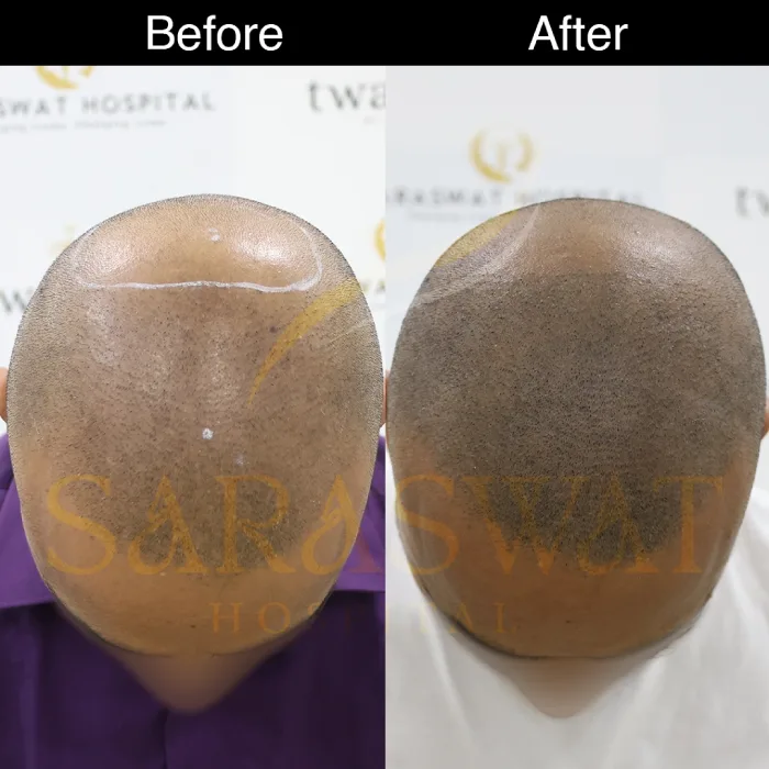 scalp micropigmentation before and after