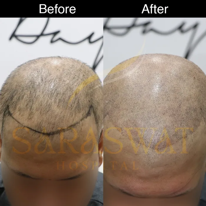 scalp micropigmentation before and after