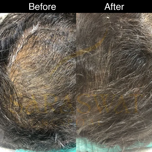 scalp micropigmentation before and after