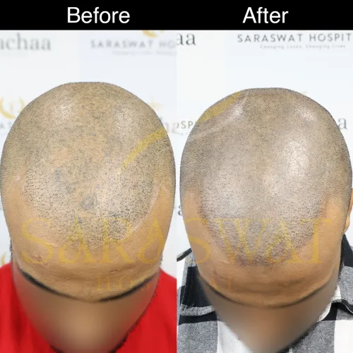 scalp micropigmentation before and after