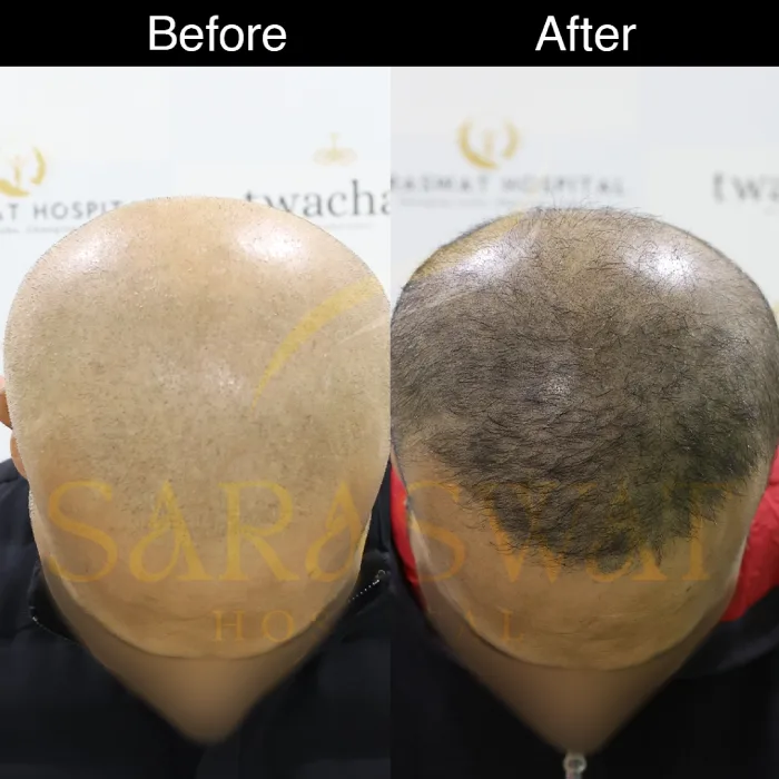 scalp micropigmentation before and after