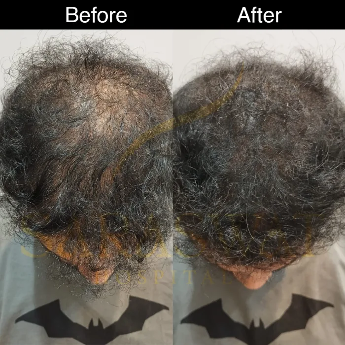 scalp micropigmentation before and after
