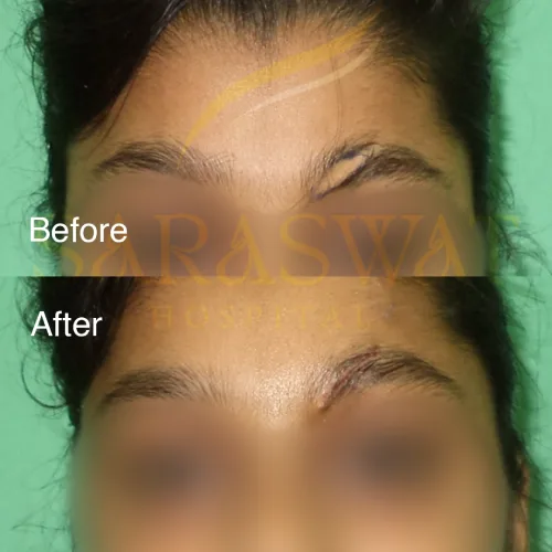 Scar Reduction Before and After