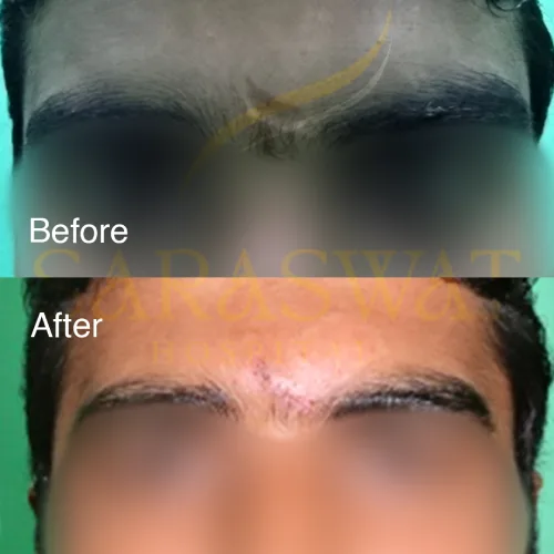 Scar Reduction Before and After