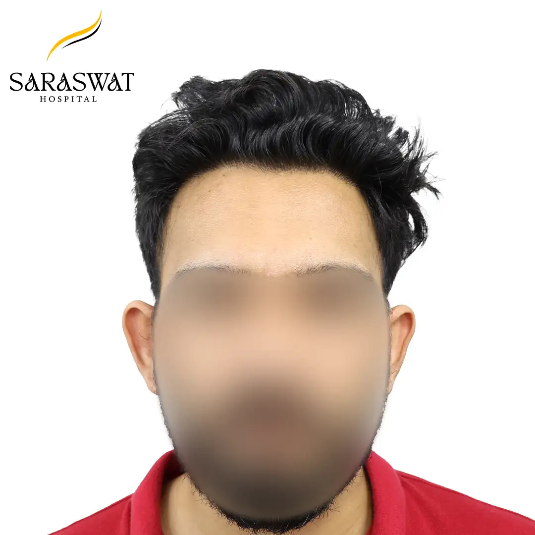 FUE Hair Transplant