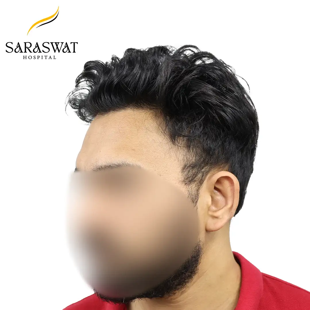 90 Degree Left FUE Hair Transplant Result After Procedure