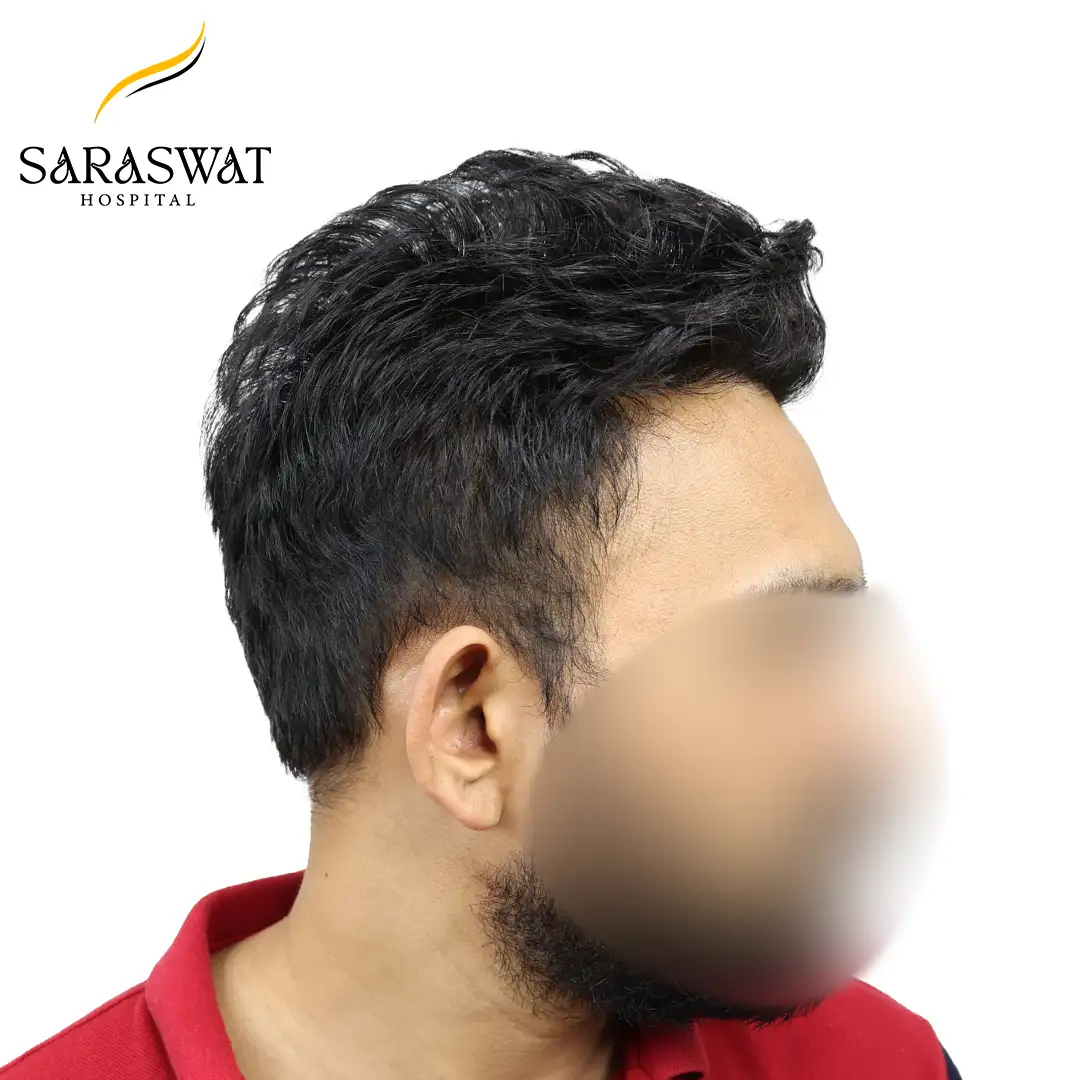 Hair Transplant Before After