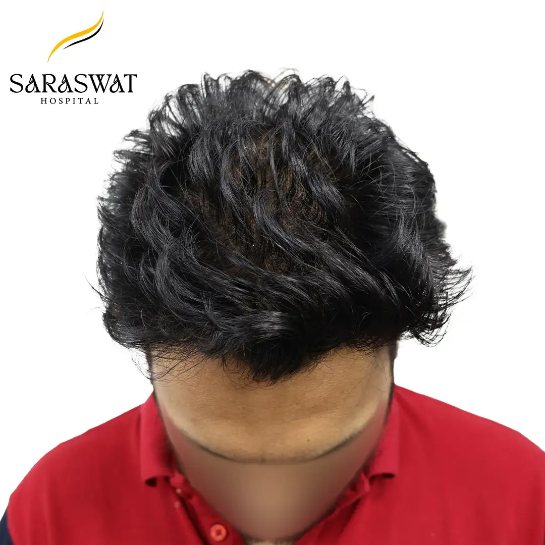 Hair Transplant Before After