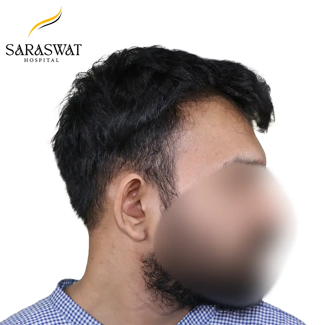 90 Degree Right FUE Hair Transplant Result Before Procedure