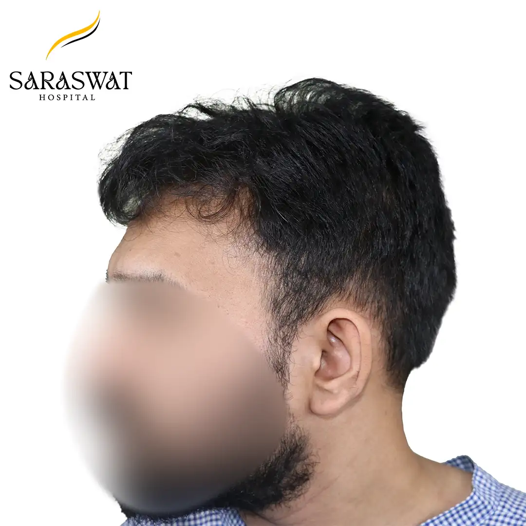 90 Degree Left FUE Hair Transplant Result Before Procedure