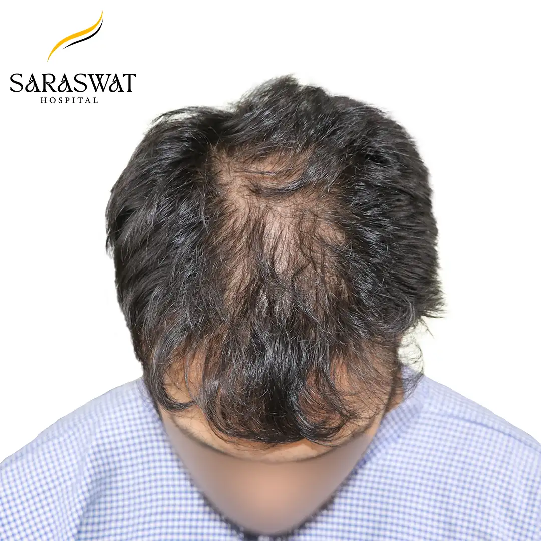 Top FUE Hair Transplant Result Before Procedure