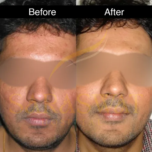 skin resurfacing 1