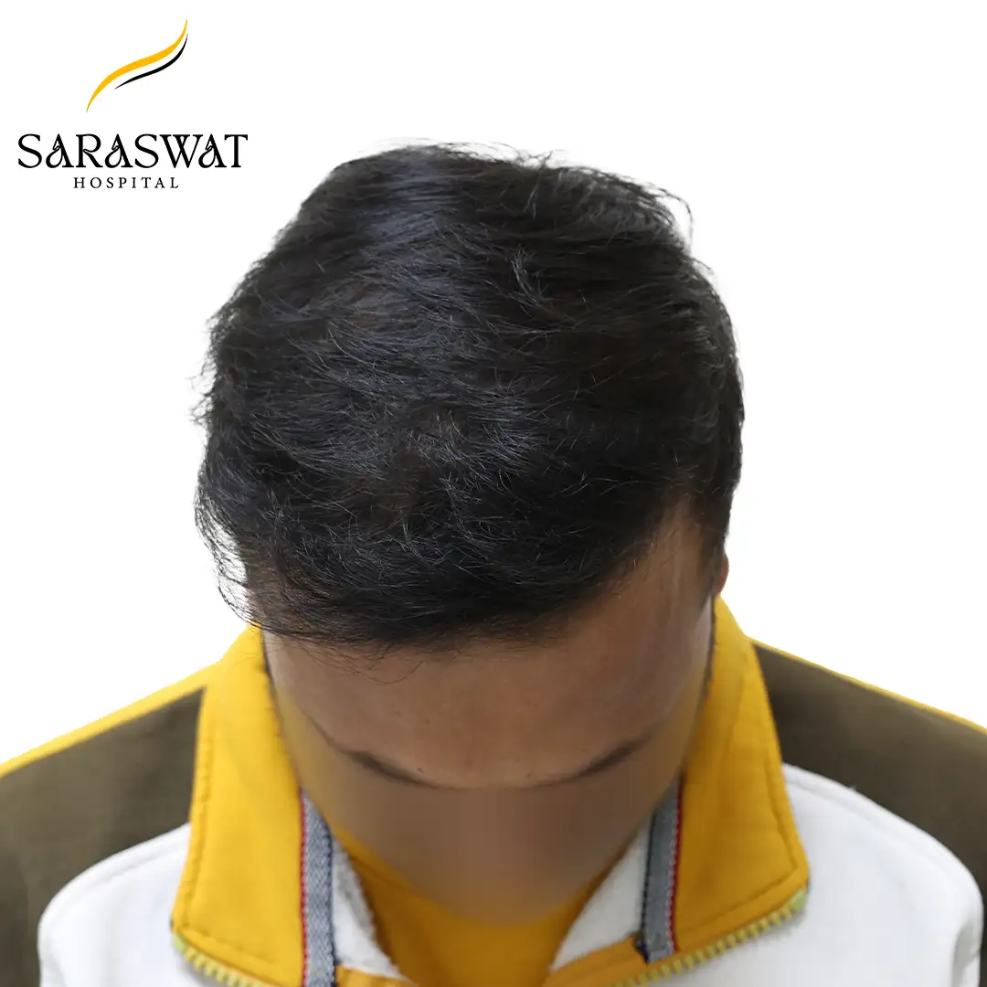Top FUE Hair Transplant Result After Procedure