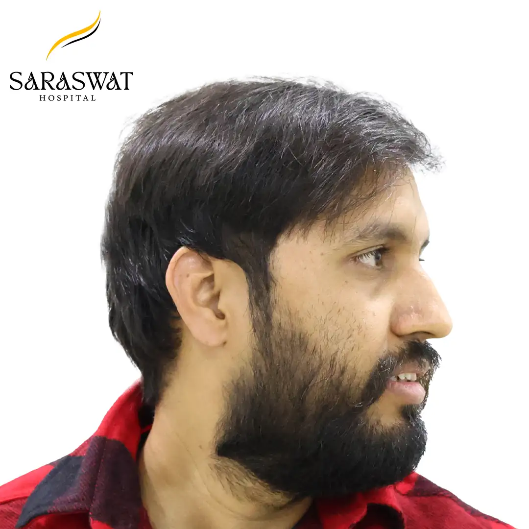 Hair Transplant Before and After Results