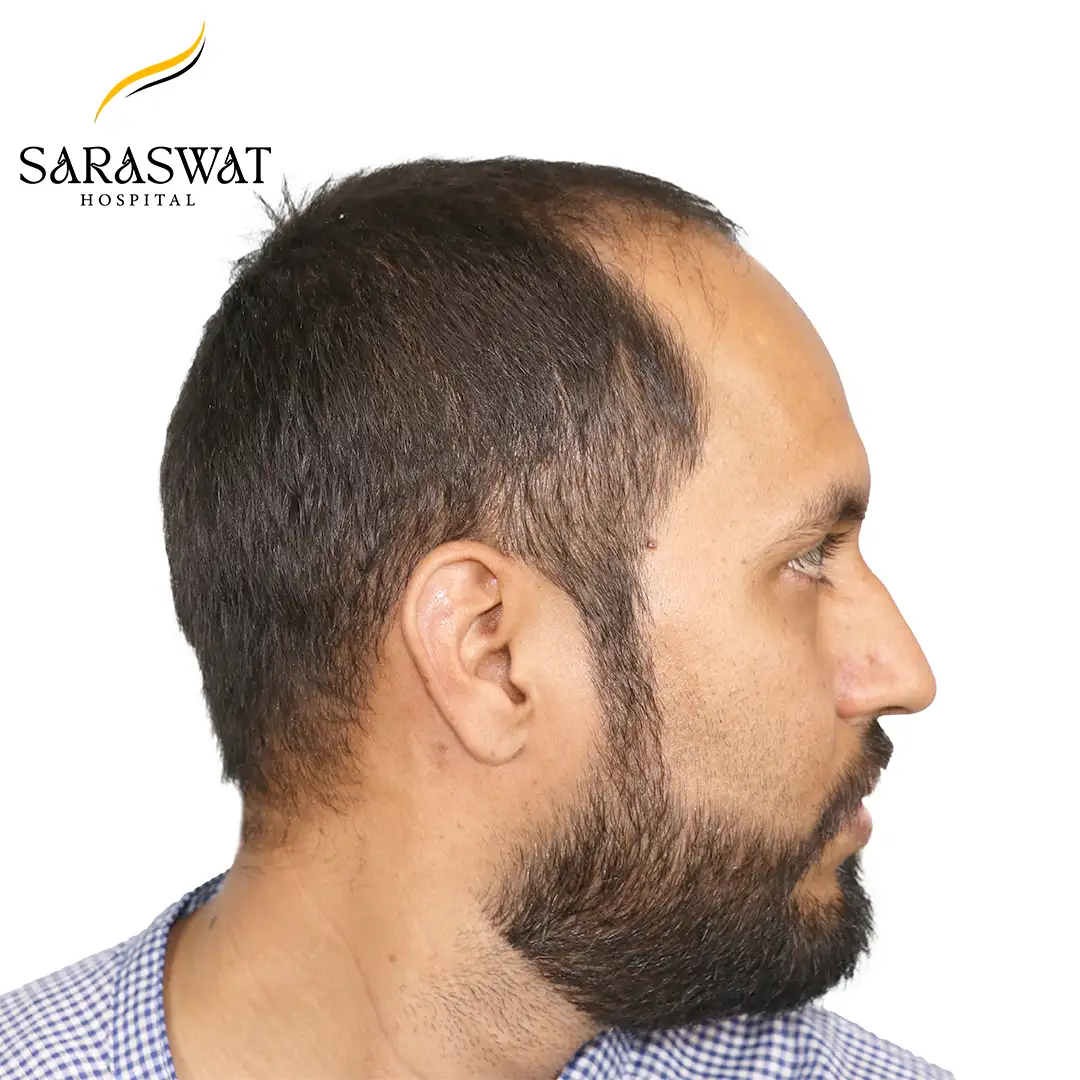 90 Degree Right FUE Hair Transplant Result Before Procedure