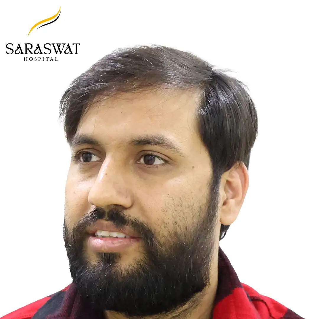 45 Degree Left FUE Hair Transplant Result After Procedure