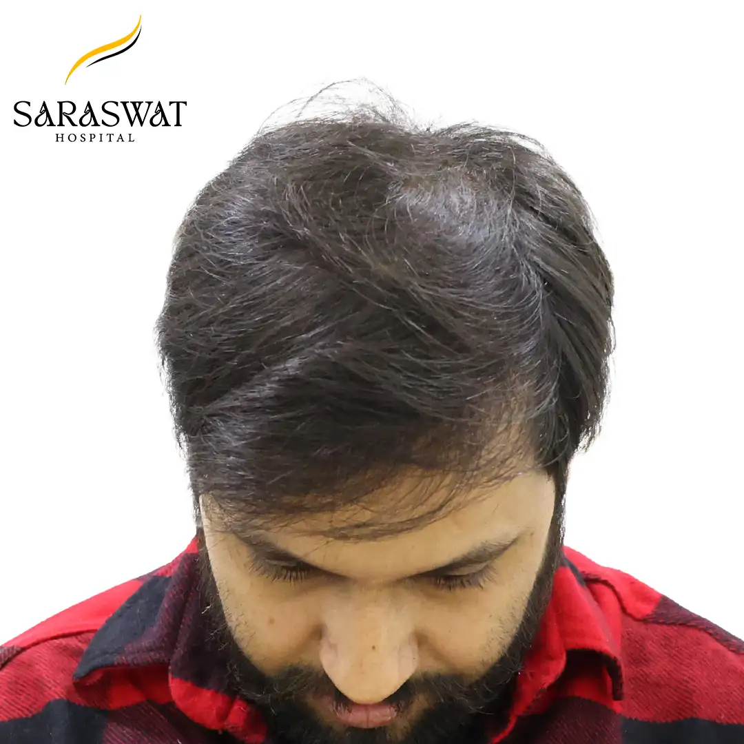 FUE Hair Transplant
