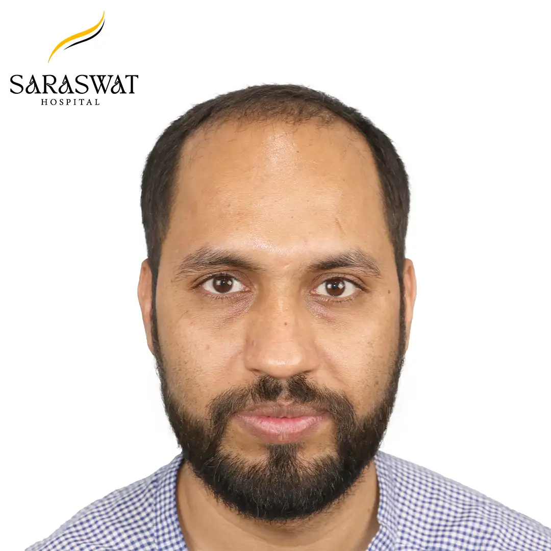 Front FUE Hair Transplant Result Before Procedure