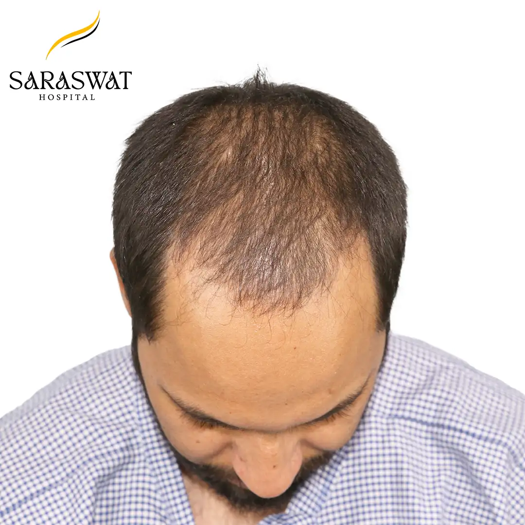 Top FUE Hair Transplant Result Before Procedure