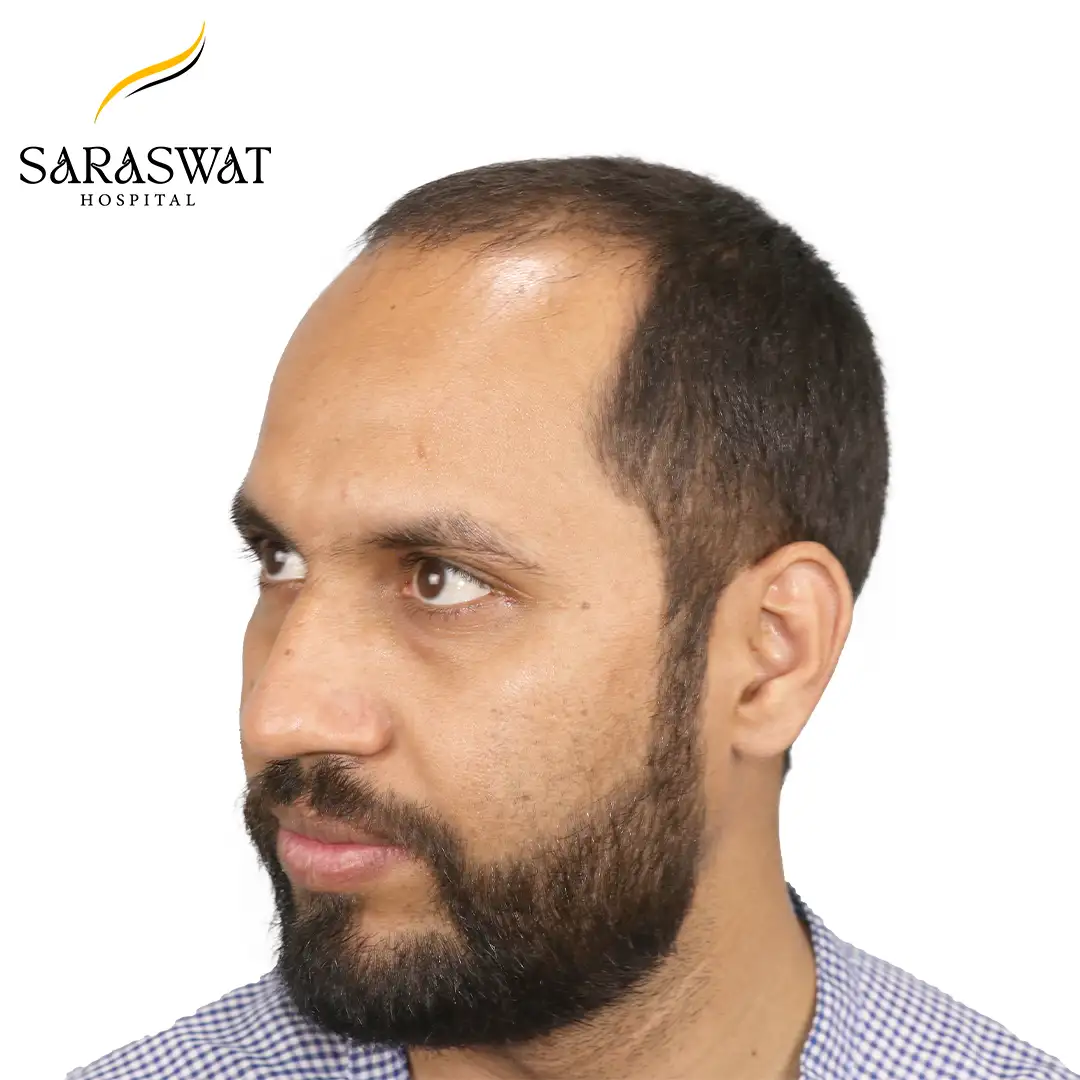 45 Degree Left FUE Hair Transplant Result Before Procedure