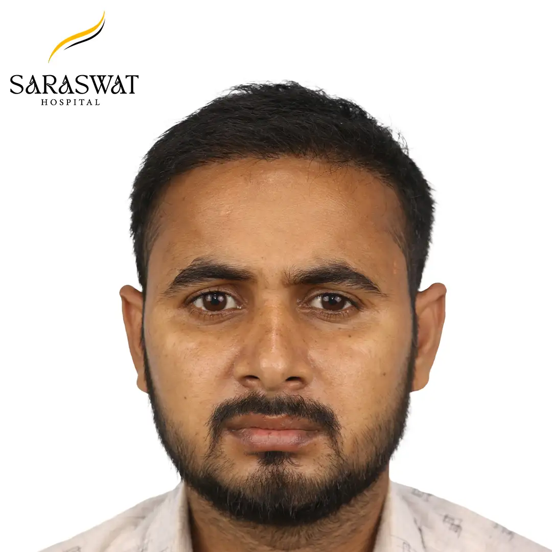 Front FUE Hair Transplant Result After Procedure