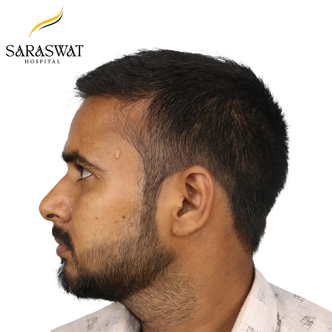 90 Degree Left FUE Hair Transplant Result After Procedure