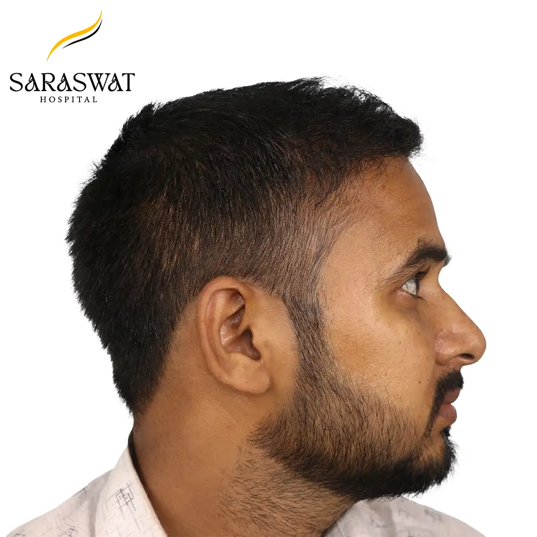 90 Degree Right FUE Hair Transplant Result After Procedure