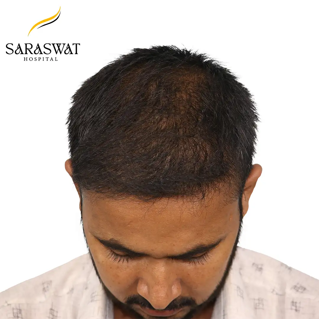 Top FUE Hair Transplant Result After Procedure