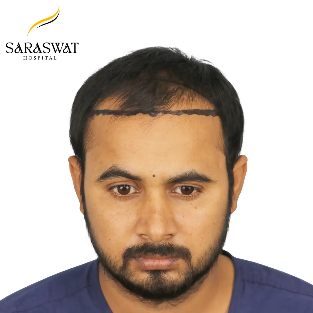 Front FUE Hair Transplant Result Before Procedure