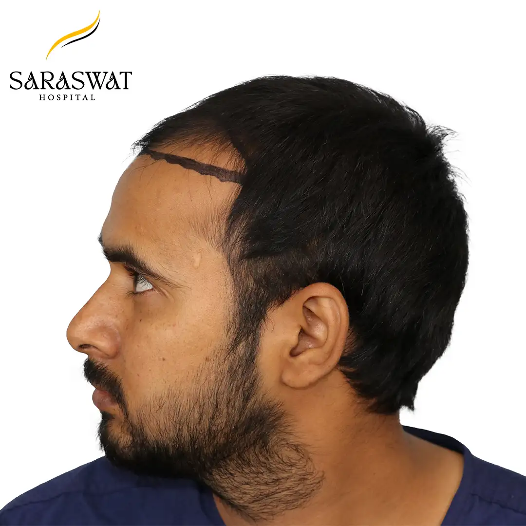 90 Degree Left FUE Hair Transplant Result Before Procedure