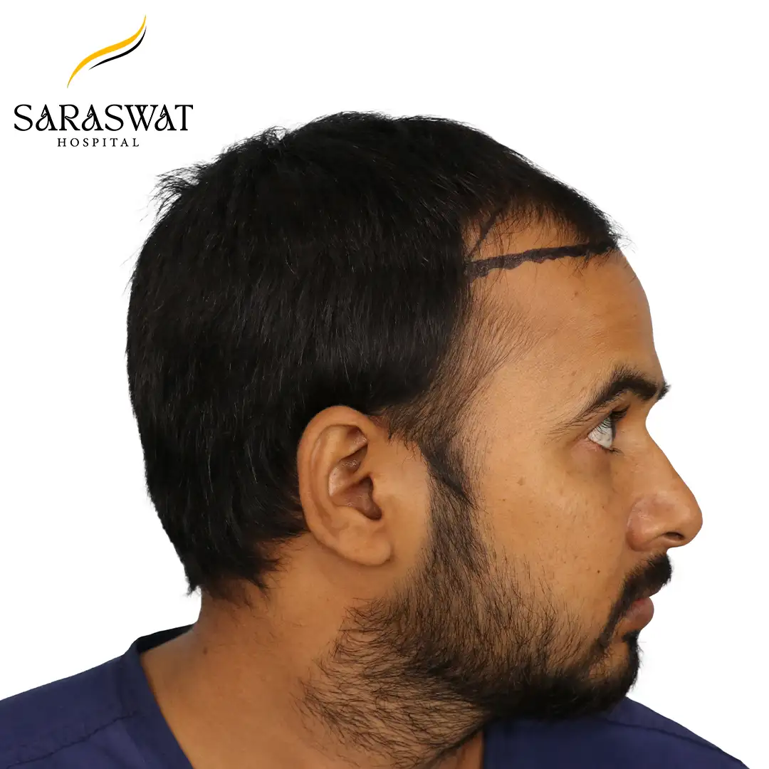 90 Degree Right FUE Hair Transplant Result Before Procedure