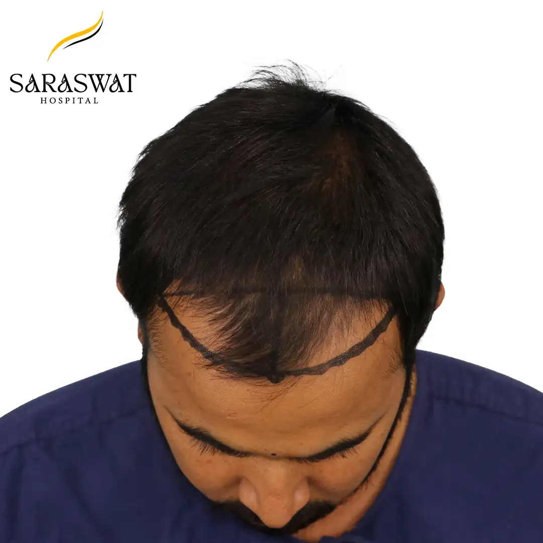 Top FUE Hair Transplant Result Before Procedure
