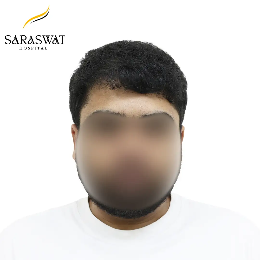 Front FUE Hair Transplant Result After Procedure