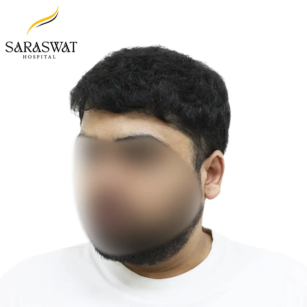 45 Degree Left FUE Hair Transplant Result After Procedure