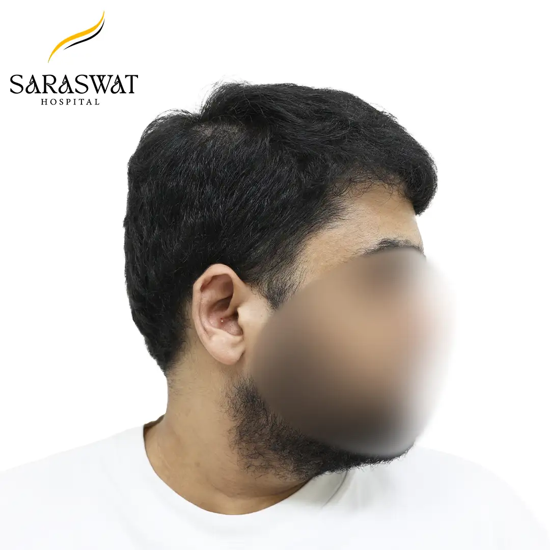 90 Degree Right FUE Hair Transplant Result After Procedure