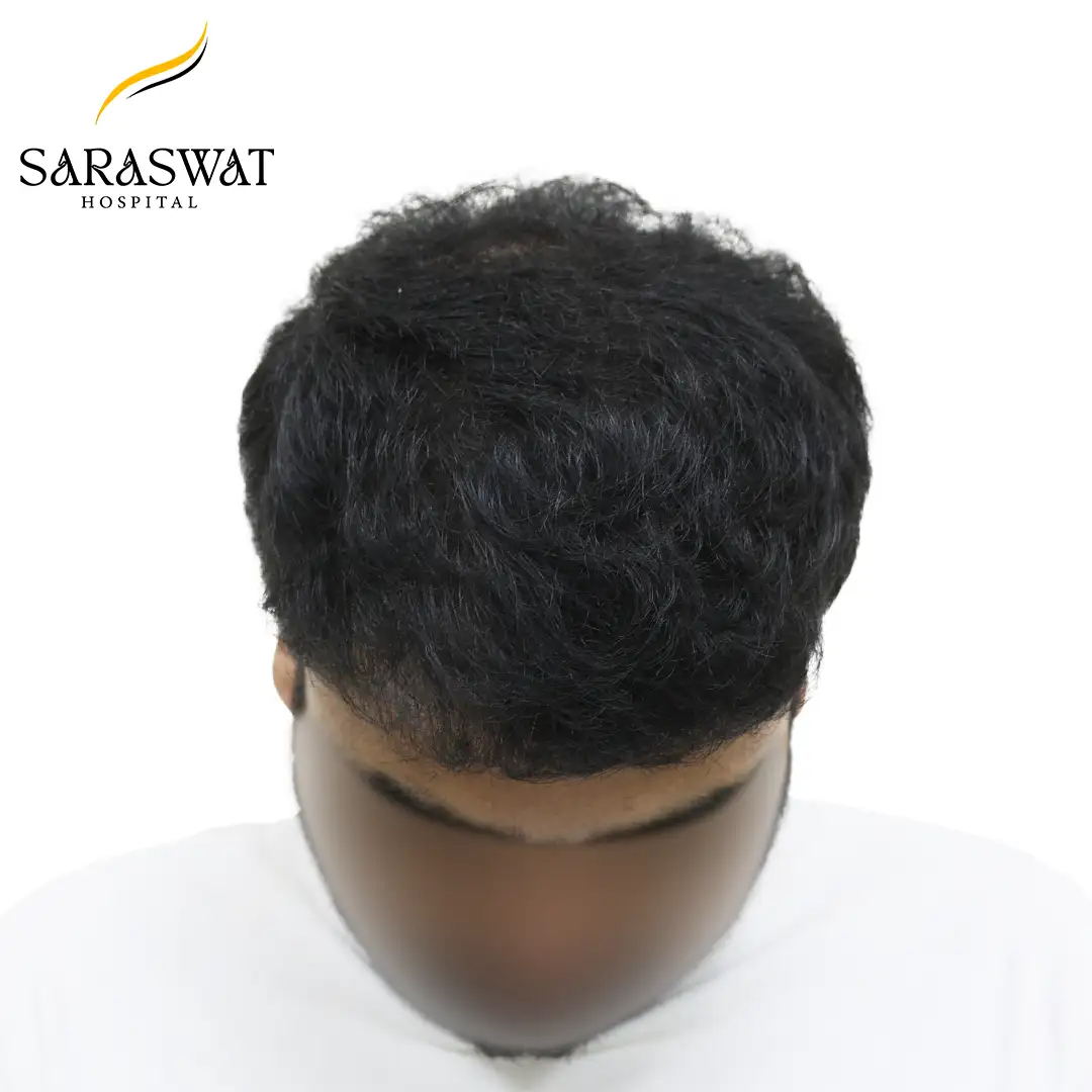 Hair Transplant Before After