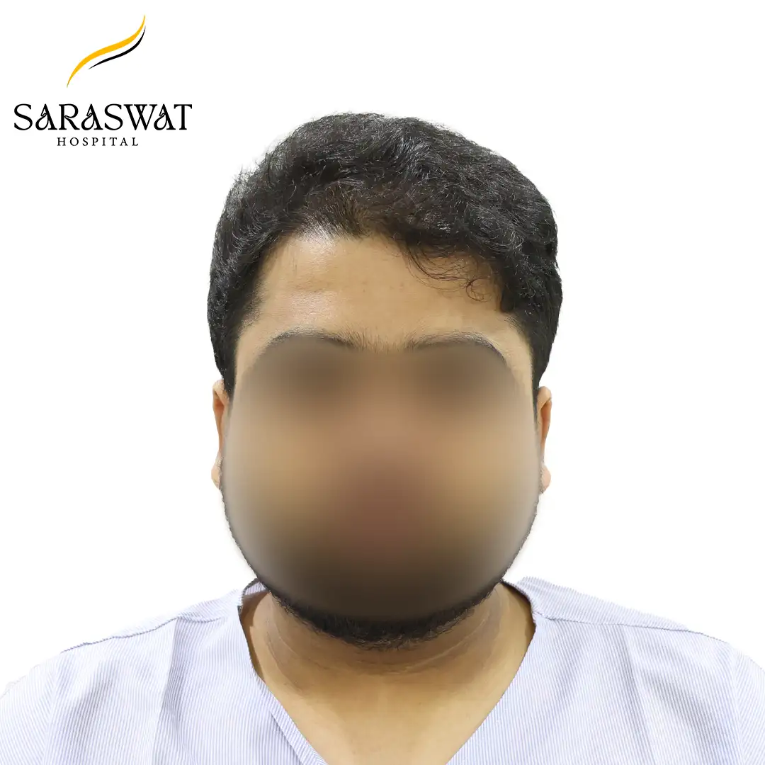 Front FUE Hair Transplant Result Before Procedure