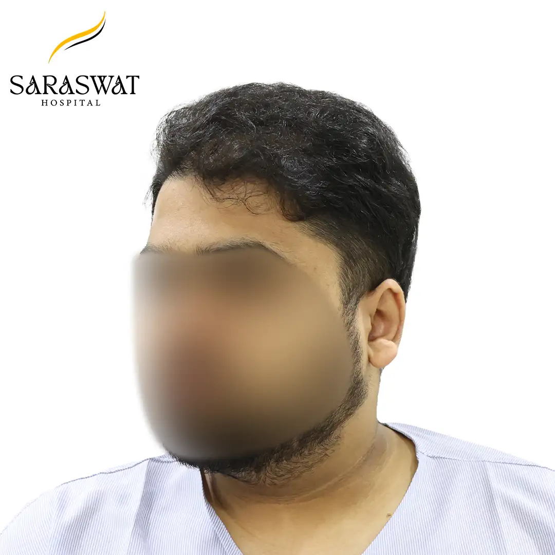 45 Degree Left FUE Hair Transplant Result Before Procedure