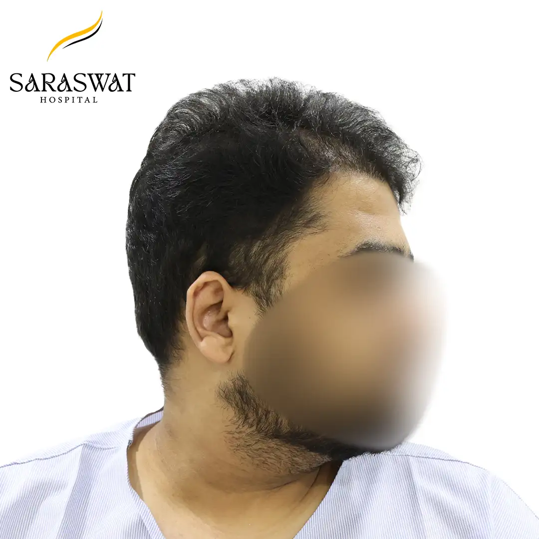 90 Degree Right FUE Hair Transplant Result Before Procedure